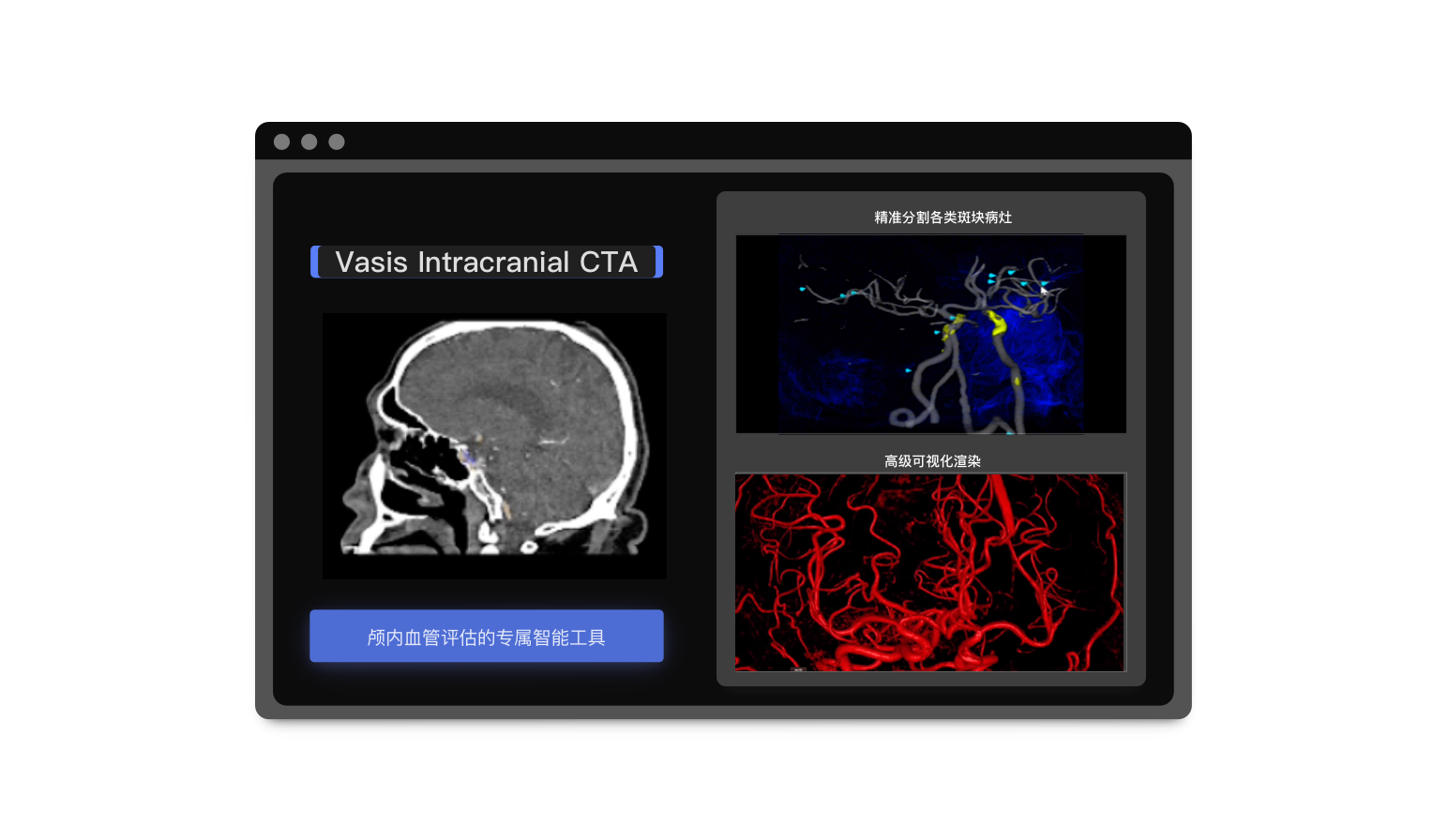 Vasis Intracranial CTA颅内动脉血管智能评估系统